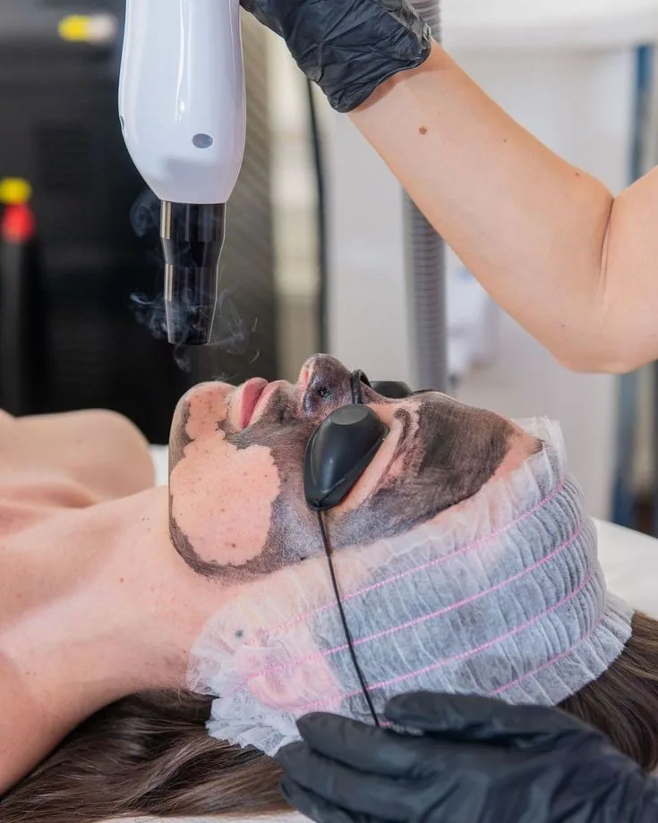 Formation Carbon Peel — Le poste et le matériel Démonstration pratique de la formation Carbon Peel
