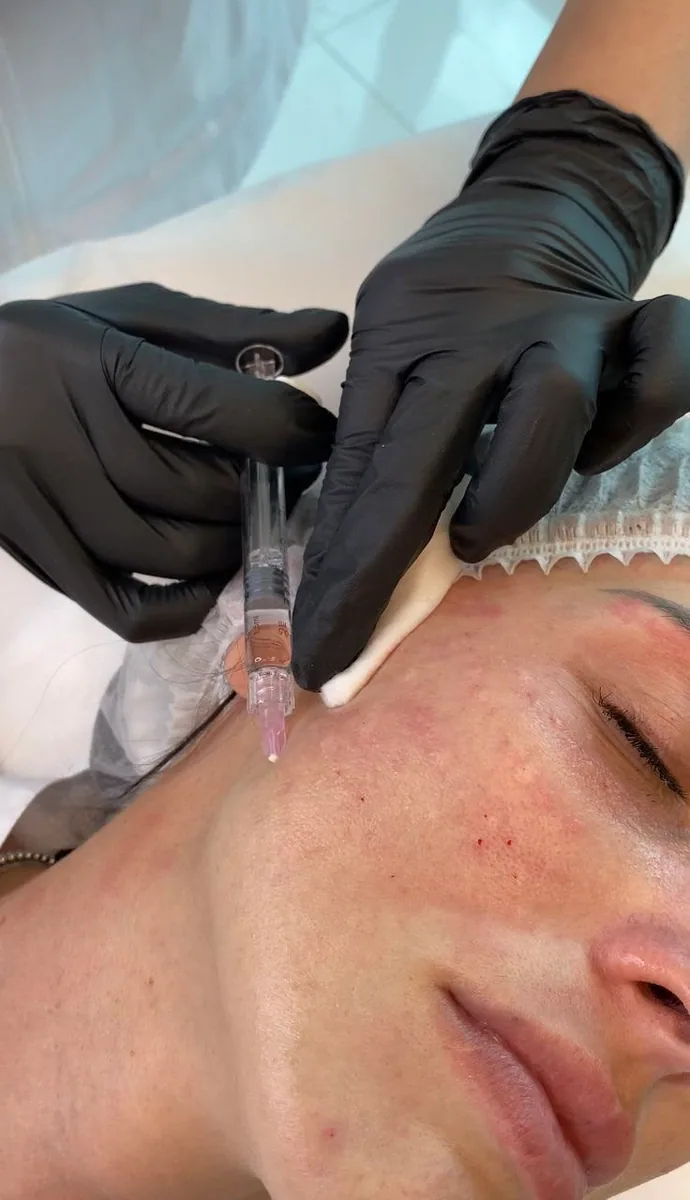 Formation Plasma Pen — Le poste et le matériel Démonstration pratique de la formation Plasma Pen