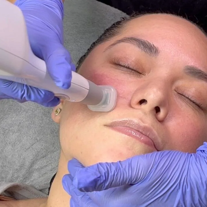 Formation Plasma Pen — La pratique accompagnée sur modèle Étape de protocole enseignée pendant la formation Plasma Pen